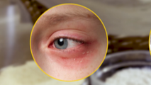 Lebensmittelallergie